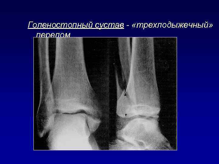 Голеностопный сустав - «трехлодыжечный» перелом 