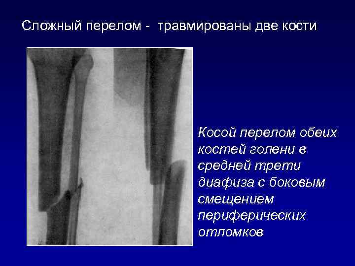 Презентация перелом костей голени