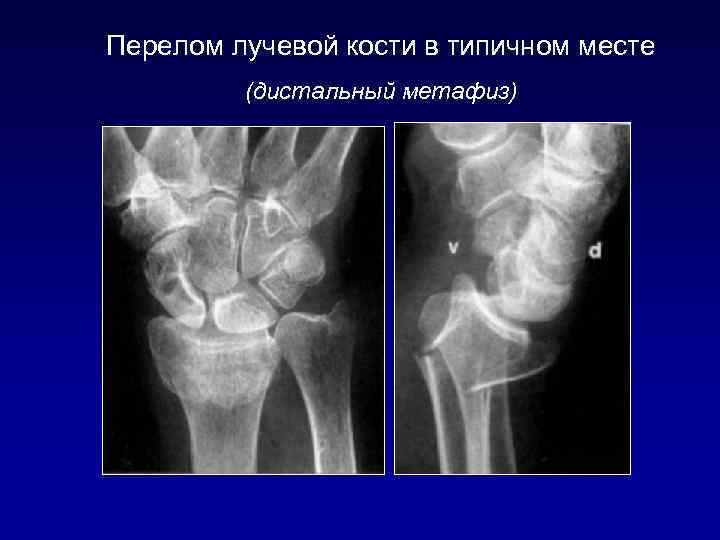 Перелом лучевой кости в типичном месте (дистальный метафиз) 