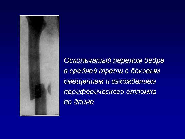 Оскольчатый перелом бедра в средней трети с боковым смещением и захождением периферического отломка по