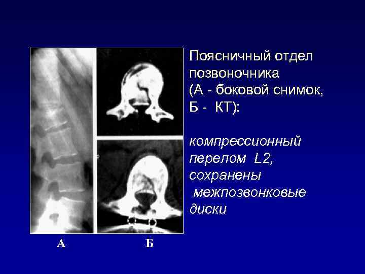 Поясничный отдел позвоночника (А - боковой снимок, Б - КТ): компрессионный перелом L 2,