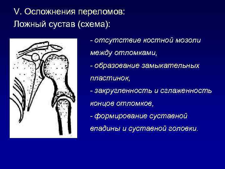 Суставы развитие. Классификация ложных суставов. Ложный сустав плечевой кости.