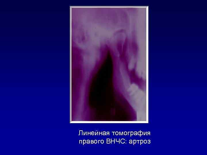 Линейная томография правого ВНЧС: артроз 