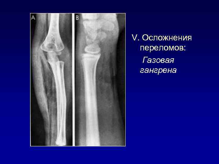 V. Осложнения переломов: Газовая гангрена 