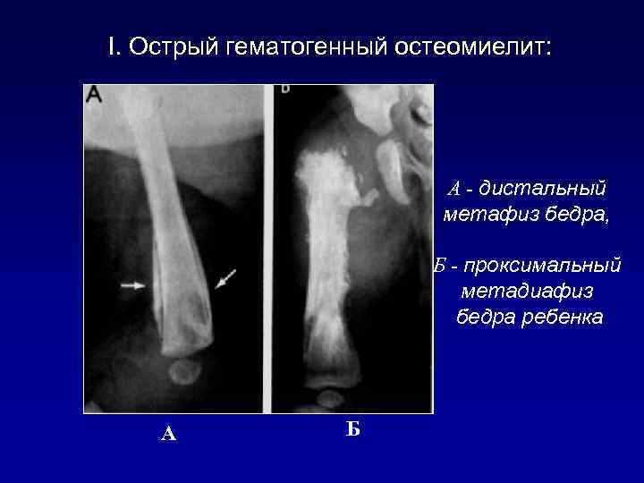 I. Острый гематогенный остеомиелит: А - дистальный метафиз бедра, Б - проксимальный метадиафиз бедра