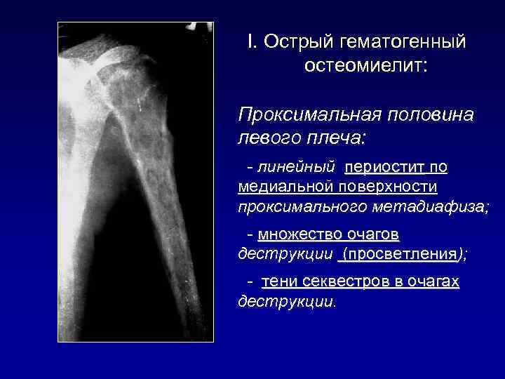 I. Острый гематогенный остеомиелит: Проксимальная половина левого плеча: - линейный периостит по медиальной поверхности