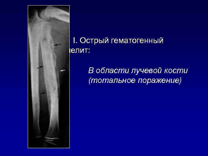 I. Острый гематогенный остеомиелит: В области лучевой кости (тотальное поражение) 
