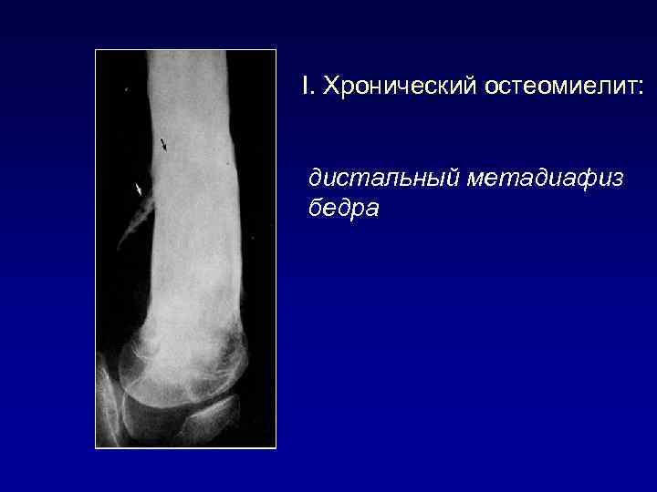 I. Хронический остеомиелит: дистальный метадиафиз бедра 