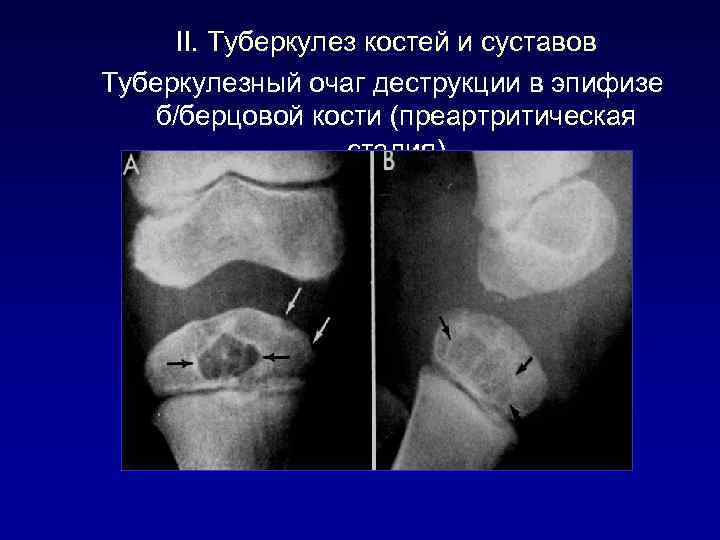 II. Туберкулез костей и суставов Туберкулезный очаг деструкции в эпифизе б/берцовой кости (преартритическая стадия)