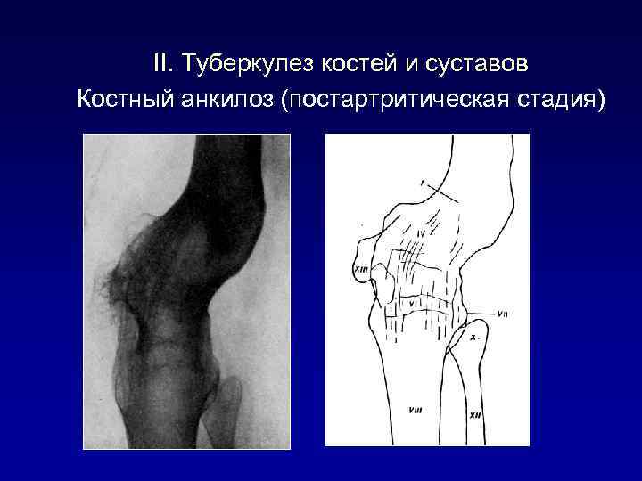 II. Туберкулез костей и суставов Костный анкилоз (постартритическая стадия) 