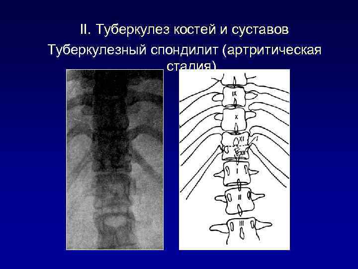 II. Туберкулез костей и суставов Туберкулезный спондилит (артритическая стадия) 
