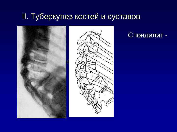 II. Туберкулез костей и суставов Спондилит - артритическая стадия 