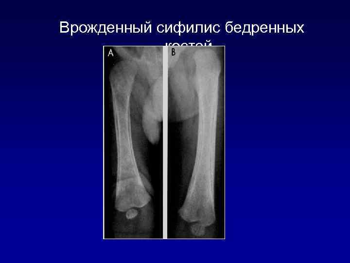 Врожденный сифилис бедренных костей 