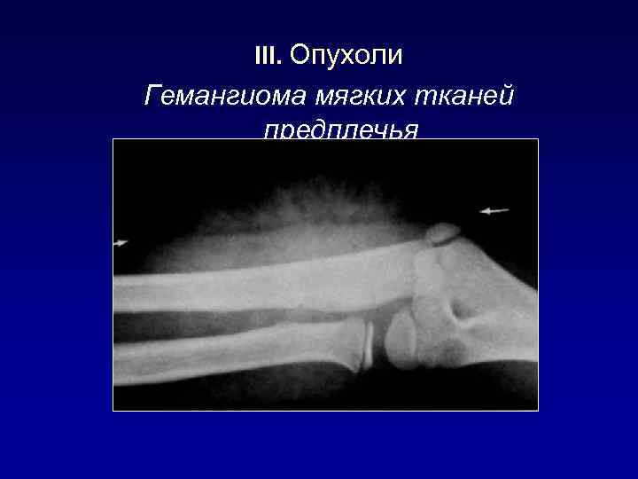 III. Опухоли Гемангиома мягких тканей предплечья 