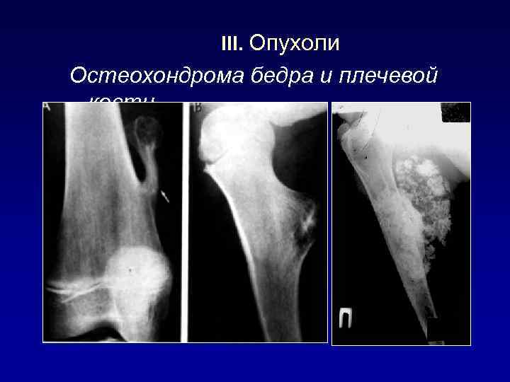 Остеохондрома бедренной. Остеохондрома бедренной кости кт. Остеохондрома коленного сустава рентген. Остеохондрома плечевой кости на кт. Экзостоз плечевой кости.