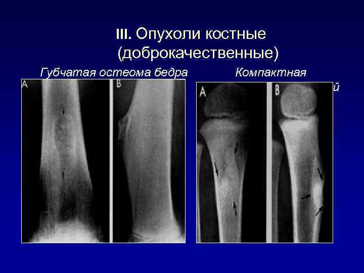 III. Опухоли костные (доброкачественные) Губчатая остеома бедра остеома кости Компактная б/берцовой 