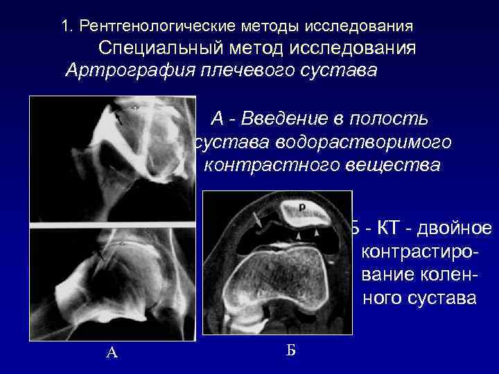 1. Рентгенологические методы исследования Специальный метод исследования Артрография плечевого сустава А - Введение в