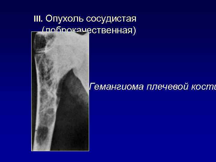 III. Опухоль сосудистая (доброкачественная) Гемангиома плечевой кости 