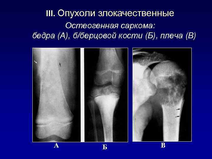 III. Опухоли злокачественные Остеогенная саркома: бедра (А), б/берцовой кости (Б), плеча (В) А Б