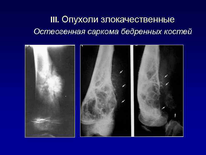 III. Опухоли злокачественные Остеогенная саркома бедренных костей 