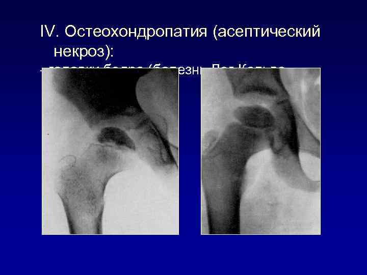 IV. Остеохондропатия (асептический некроз): - головки бедра (болезнь Лег-Кальве. Пертеса) 