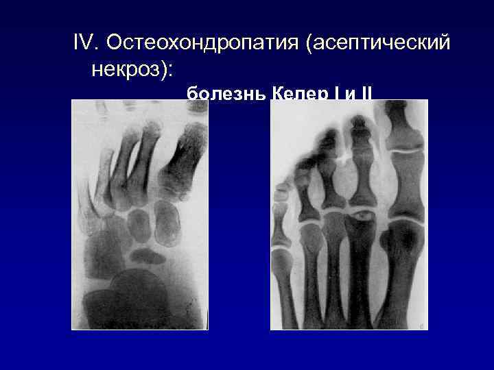 IV. Остеохондропатия (асептический некроз): болезнь Келер I и II 