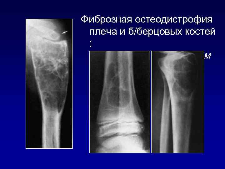 Фиброзная остеодистрофия плеча и б/берцовых костей : остеобластокластом ы 