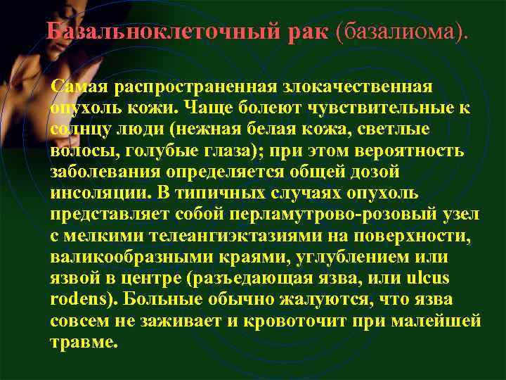  Базальноклеточный рак (базалиома). Самая распространенная злокачественная опухоль кожи. Чаще болеют чувствительные к солнцу