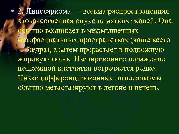  • 2. Липосаркома — весьма распространенная злокачественная опухоль мягких тканей. Она обычно возникает