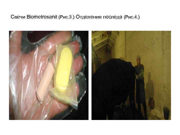 Свечи Biometrosanit (Рис. 3. ) Отделения последа (Рис. 4. ) 