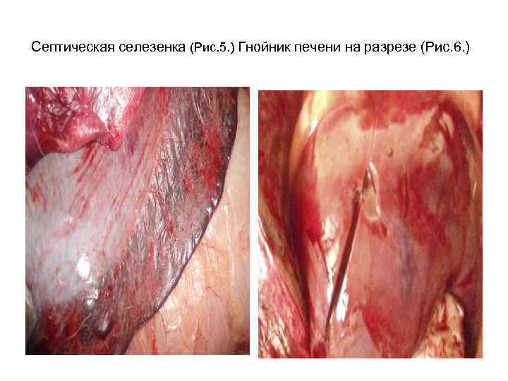 Септическая селезенка (Рис. 5. ) Гнойник печени на разрезе (Рис. 6. ) 