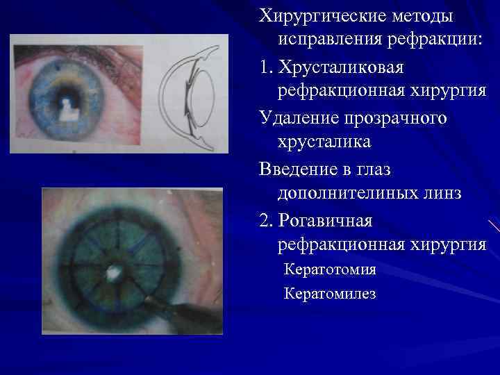 Хирургические методы исправления рефракции: 1. Хрусталиковая рефракционная хирургия Удаление прозрачного хрусталика Введение в глаз