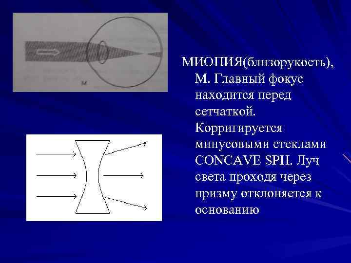 МИОПИЯ(близорукость), М. Главный фокус находится перед сетчаткой. Корригируется минусовыми стеклами CONCAVE SPH. Луч света