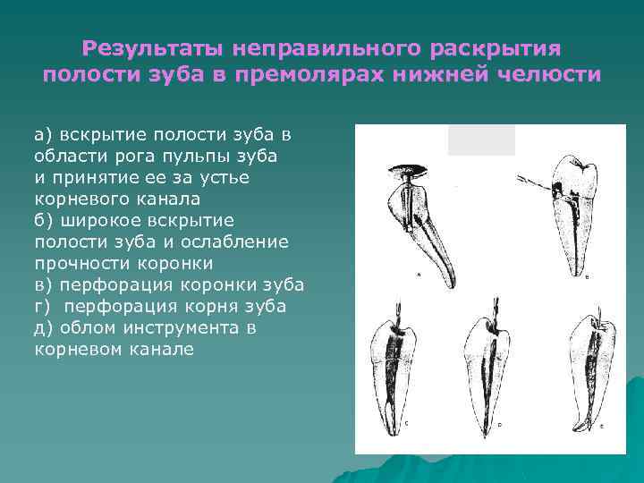 Результаты неправильного раскрытия полости зуба в премолярах нижней челюсти а) вскрытие полости зуба в