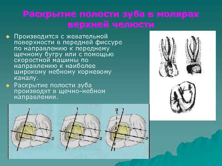 Раскрытие полости зуба в молярах верхней челюсти u u Производится с жевательной поверхности в