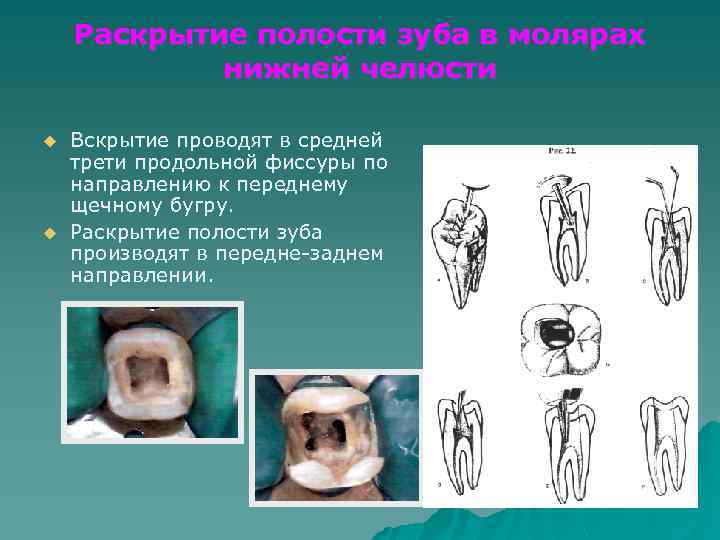 Раскрытие полости зуба в молярах нижней челюсти u u Вскрытие проводят в средней трети