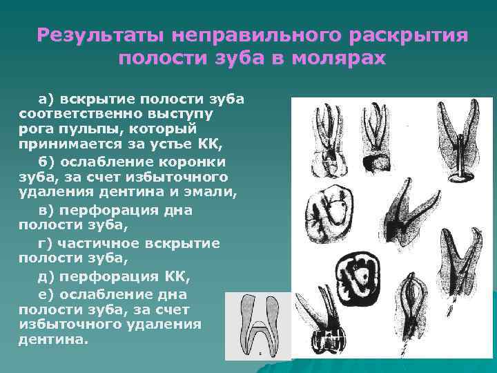 Результаты неправильного раскрытия полости зуба в молярах а) вскрытие полости зуба соответственно выступу рога
