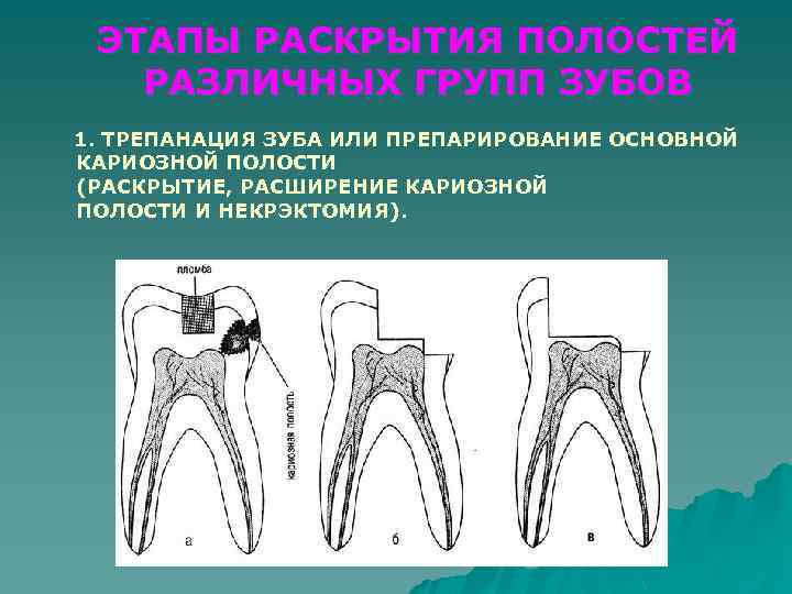 ЭТАПЫ РАСКРЫТИЯ ПОЛОСТЕЙ РАЗЛИЧНЫХ ГРУПП ЗУБОВ 1. ТРЕПАНАЦИЯ ЗУБА ИЛИ ПРЕПАРИРОВАНИЕ ОСНОВНОЙ КАРИОЗНОЙ ПОЛОСТИ