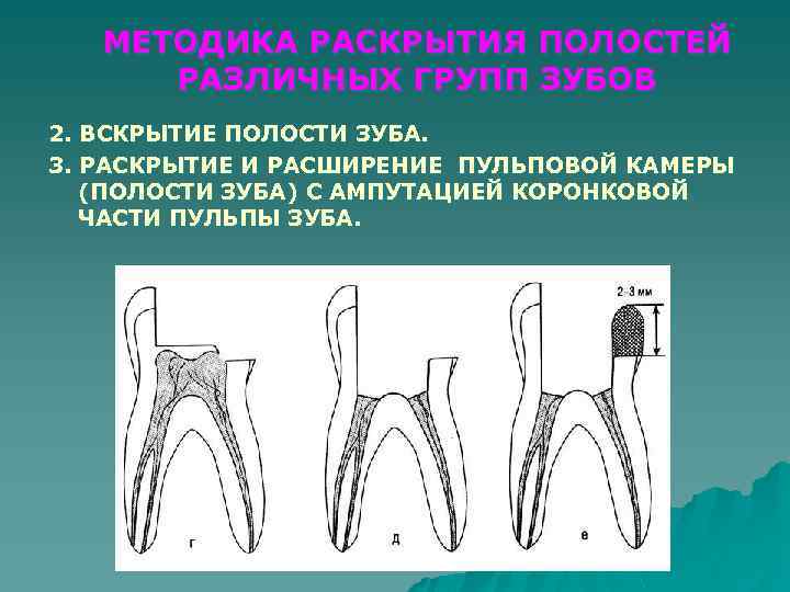 МЕТОДИКА РАСКРЫТИЯ ПОЛОСТЕЙ РАЗЛИЧНЫХ ГРУПП ЗУБОВ 2. ВСКРЫТИЕ ПОЛОСТИ ЗУБА. 3. РАСКРЫТИЕ И РАСШИРЕНИЕ