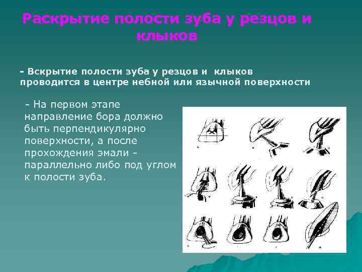 Раскрытие полости зуба у резцов и клыков - Вскрытие полости зуба у резцов и