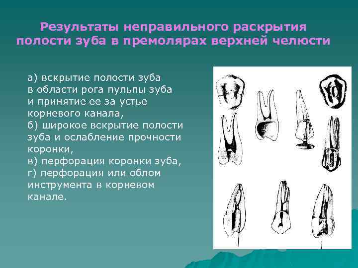 Результаты неправильного раскрытия полости зуба в премолярах верхней челюсти а) вскрытие полости зуба в