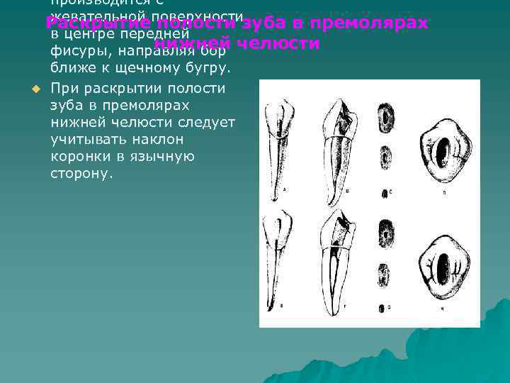 производится с жевательной полости Раскрытиеповерхностизуба в премолярах в центре передней нижней фисуры, направляя бор