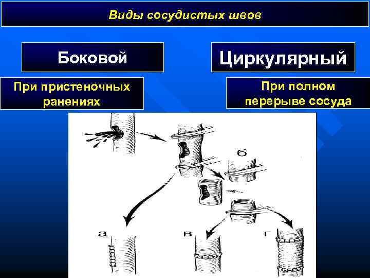 Виды сосудистых швов Боковой При пристеночных ранениях Циркулярный При полном перерыве сосуда 