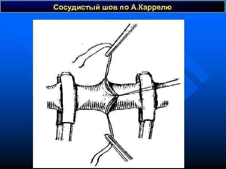 Сосудистый шов по А. Каррелю 