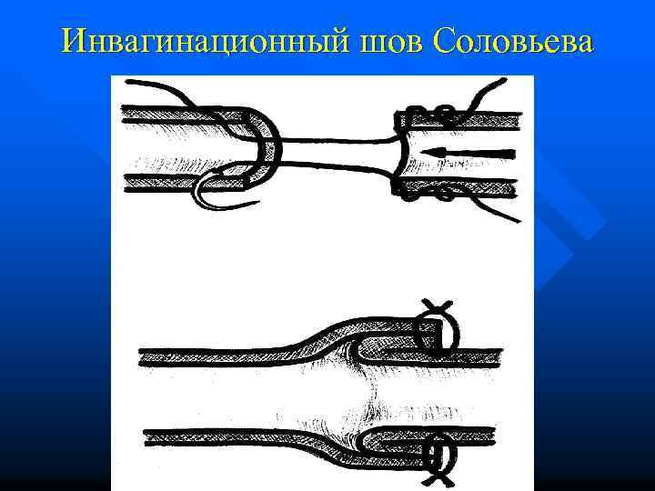 Инвагинационный шов Соловьева 