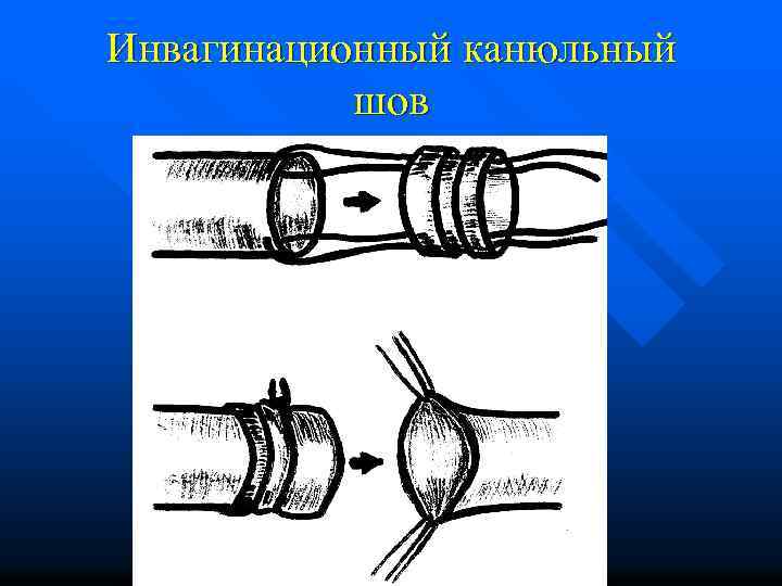 Инвагинационный канюльный шов 