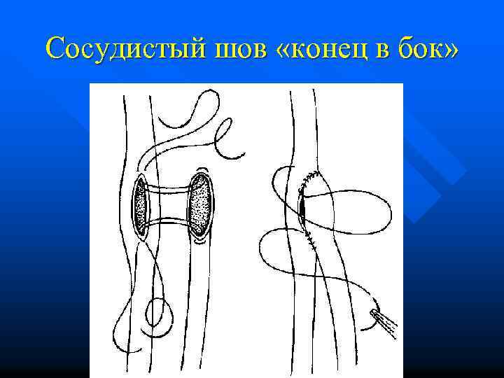 Сосудистый шов «конец в бок» 