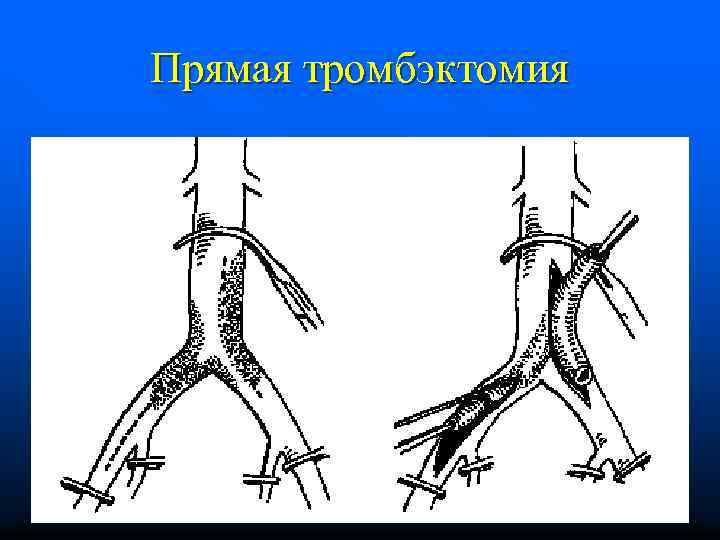 Прямая тромбэктомия 