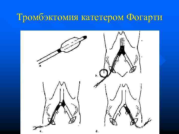 Тромбэктомия катетером Фогарти 