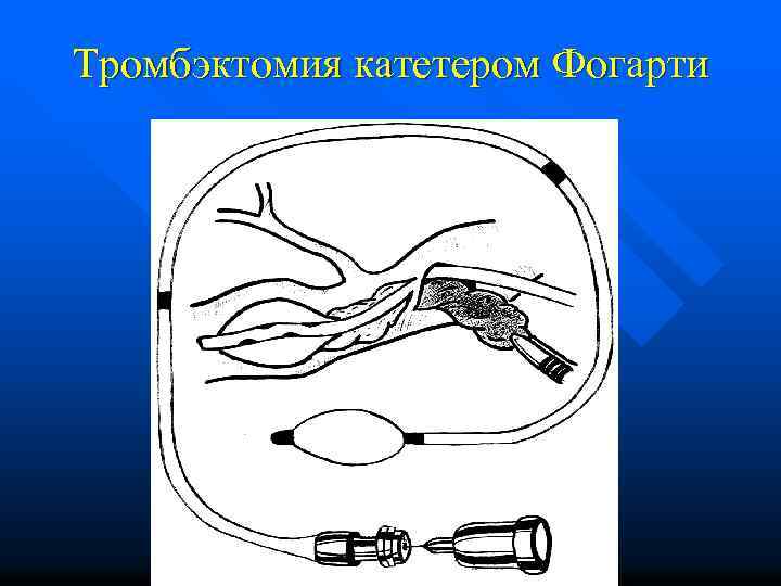 Тромбэктомия катетером Фогарти 